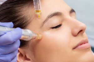 anti-aging-mesotherapy-microneedling