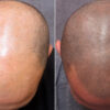 hair-tattoo-scalp-micropigmentation-use-leedfrost-10.56-lidocaine-cream