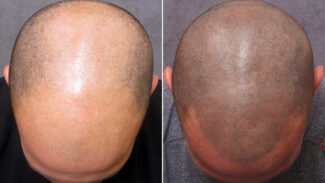 hair-tattoo-scalp-micropigmentation-use-leedfrost-10.56-lidocaine-cream