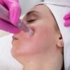 microneedling-on-face