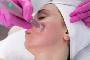 microneedling-on-face