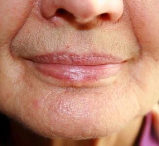 nasolabial-folds-wrinkles-around-mouth