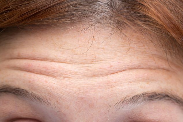 use-mesoheal-dual-deep-forehead-wrinkles