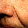 thick-skin-deep-wrinkles-nasolabial-folds-enlarged-pores