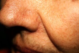 thick-skin-deep-wrinkles-nasolabial-folds-enlarged-pores